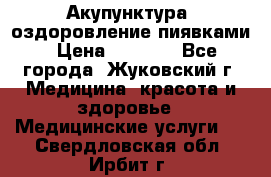 Акупунктура, оздоровление пиявками › Цена ­ 3 000 - Все города, Жуковский г. Медицина, красота и здоровье » Медицинские услуги   . Свердловская обл.,Ирбит г.